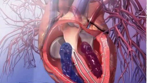 Берут ли в армию с пороком сердца, что говорят врачи